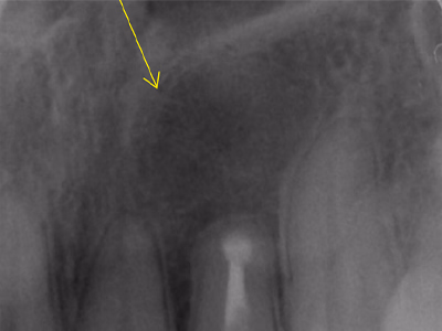 上顎臼歯部の治療後デンタルX線写真。歯根尖部透過像の変化が確認できる(矢印)。