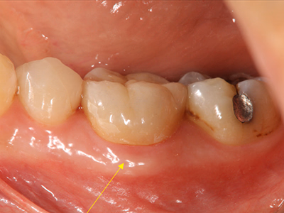 下顎臼歯部の治療後口腔内写真。歯肉の炎症が改善している(矢印)。
