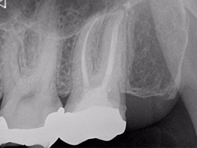 補綴装置装着歯の治療後デンタルX線写真。歯根周囲骨の回復がみられる。