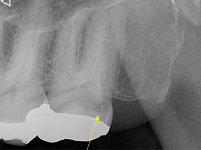 補綴装置装着歯のデンタルX線写真。歯根周囲に骨吸収像が認められる。