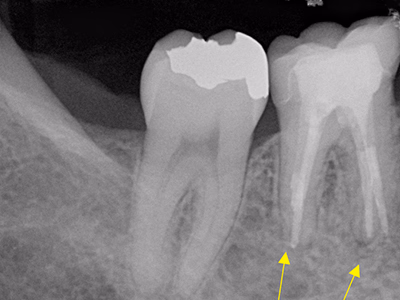 下顎小臼歯部の治療後デンタルX線写真。根尖部透過像の改善が認められる(矢印)。