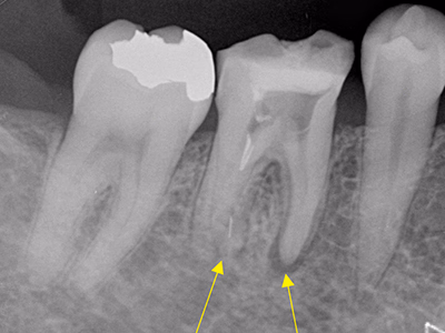 下顎小臼歯部のデンタルX線写真。根尖部に透過像が確認できる(矢印)。
