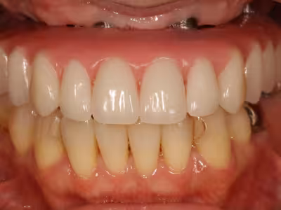 前歯部を含む口腔内の正面写真。治療後で歯列と噛み合わせが整った状態