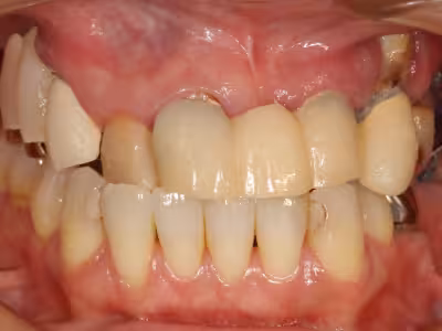 前歯部を含む口腔内の正面写真。治療前の噛み合わせと歯列の状態