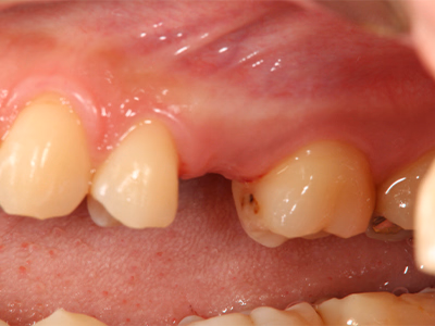 奥歯が欠損している状態の口腔内写真(治療前)