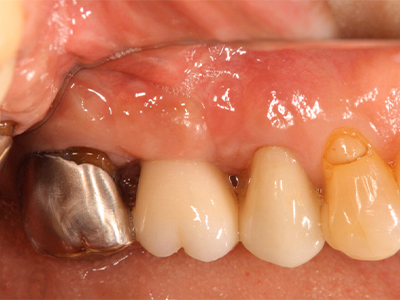 インプラント土台の上に人工歯が装着された治療後の口腔内写真