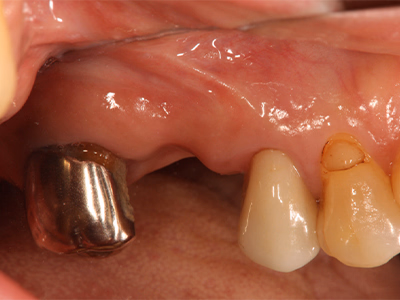 インプラント土台が装着される前の治療途中の口腔内写真