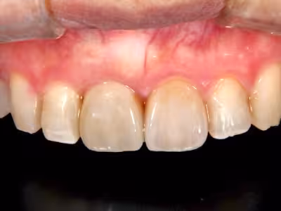 上顎前歯部にインプラント補綴を行い、歯肉形態が改善した治療後の状態