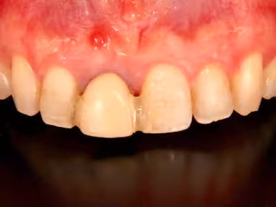 上顎前歯部に歯肉退縮と補綴物の不適合が見られる治療前の状態