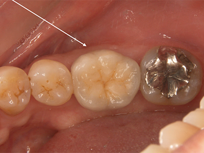 前歯部を拡大した口腔内写真。治療後で歯肉ラインと歯の形態が整った状態