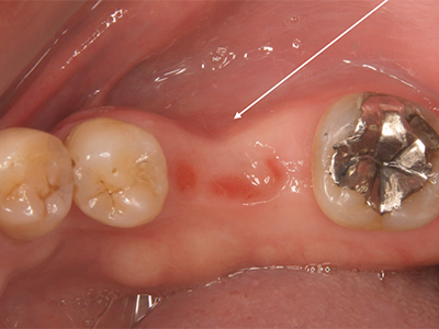 前歯部を拡大した口腔内写真。治療前の歯肉と歯の状態