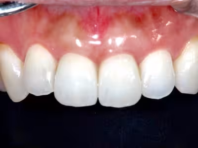 上顎前歯部の口腔内写真。補綴治療後で歯の色調と形態が改善された状態