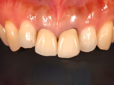 上顎前歯部の口腔内写真。治療前の歯の色調と形態の状態