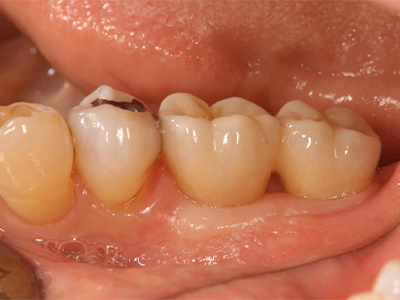 インプラントと補綴治療により、清潔感のある歯列と咬合が回復した治療後の写真