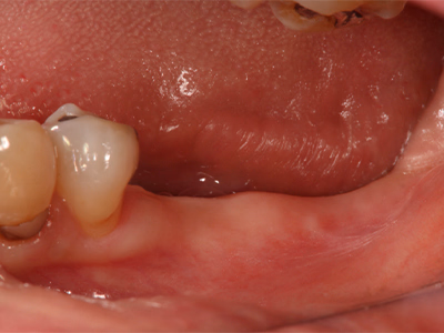 重度の歯周病により歯石沈着と歯肉退縮が見られる治療前の口腔内写真