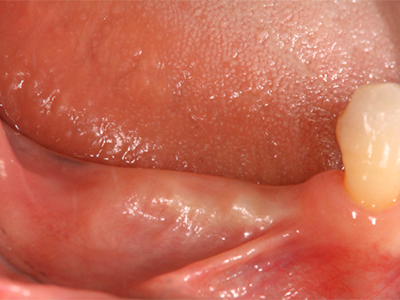 上顎前歯部を含む全体の歯列と咬合状態を示す治療前の口腔内正面写真