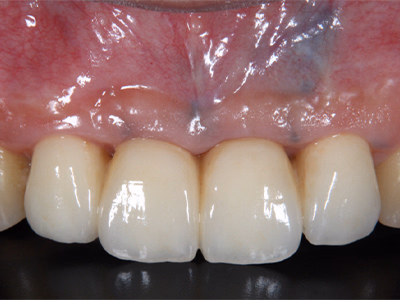 上顎前歯部に補綴物が装着され、審美性が改善した治療後の状態