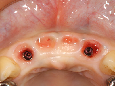 インプラント治療後、歯肉が安定し自然な歯冠形態が回復した状態