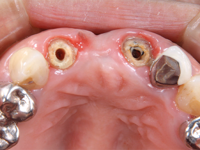 上顎前歯部にインプラント埋入直後の状態を示す治療中の口腔内写真
