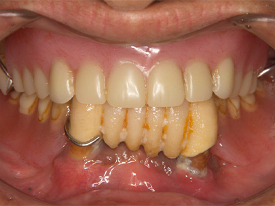 下顎臼歯部に欠損があり、歯肉の凹みが見られる治療前の口腔内写真