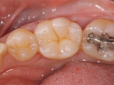 下顎臼歯部の治療後口腔内写真。咬合面が白色修復物により整えられ、周囲歯と調和している