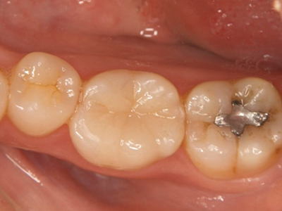 下顎臼歯部の治療後口腔内写真。白色修復物により咬合面が整えられている