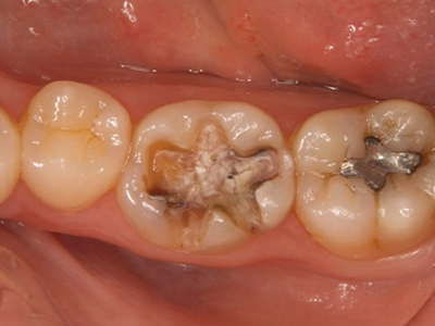 下顎臼歯部の治療前口腔内写真。金属修復物と咬合面の摩耗が確認できる