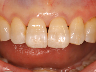 上顎前歯部の治療後写真。歯の形態と色調が自然に調和している