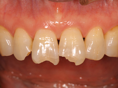 上顎前歯部の治療前写真。歯冠形態と色調の不均一が見られる