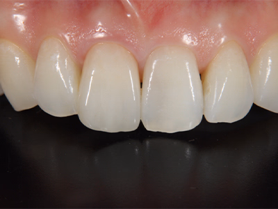 上顎前歯部の治療後写真。切縁形態が回復し自然な外観となっている