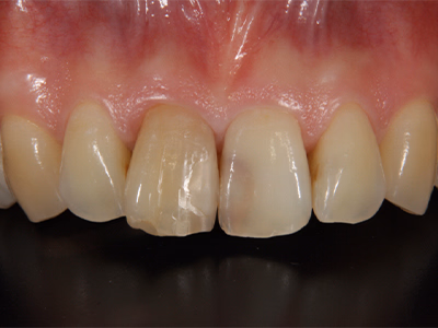 上顎前歯部の治療前写真。切縁部に欠損が認められる