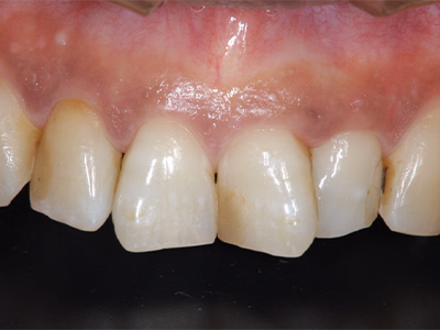 上顎前歯部の治療前写真。歯の色調にばらつきが見られる