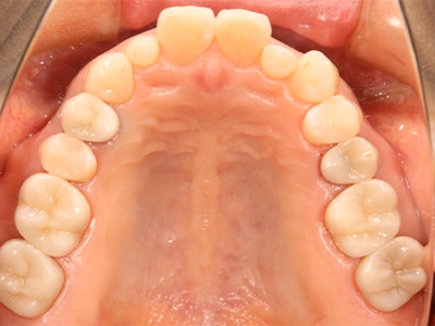 上顎歯列の治療後咬合面写真。白色修復物により統一感のある歯列となっている