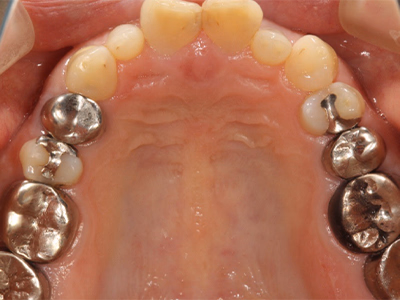 上顎歯列の治療前咬合面写真。臼歯部に金属修復物が装着されている