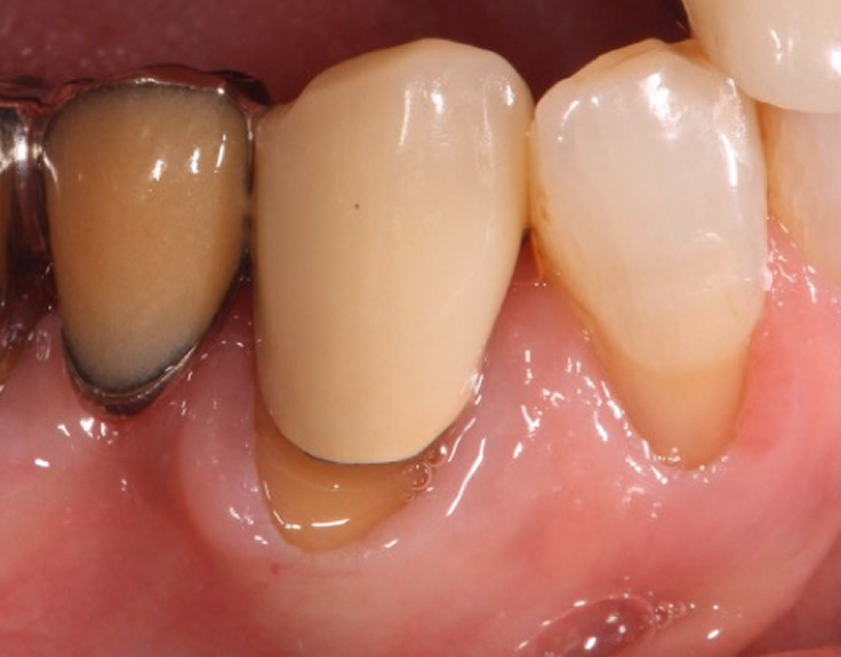 下顎臼歯部の治療前の口腔内写真。金属冠と歯肉退縮が認められる状態