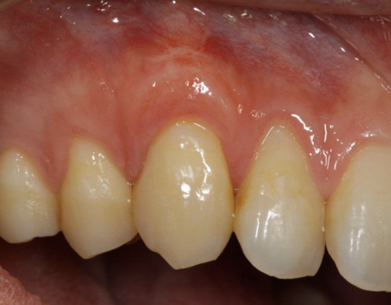 上顎前歯部の治療後の口腔内写真。歯肉ラインが整い自然な色調になった状態