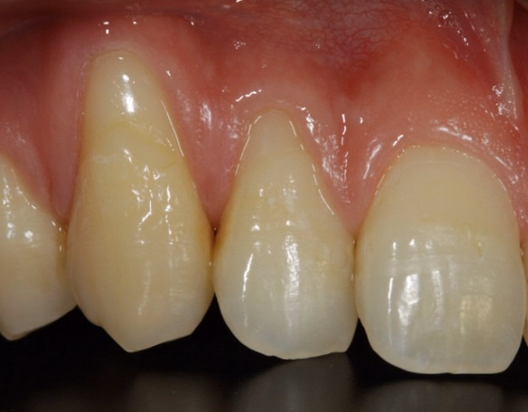 上顎前歯部の治療前の口腔内写真。歯肉の不整と色調のばらつきが見られる状態