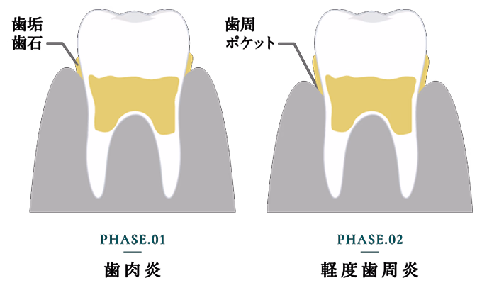 歯周病初期から中期の進行を示すイラスト（PHASE1とPHASE2）