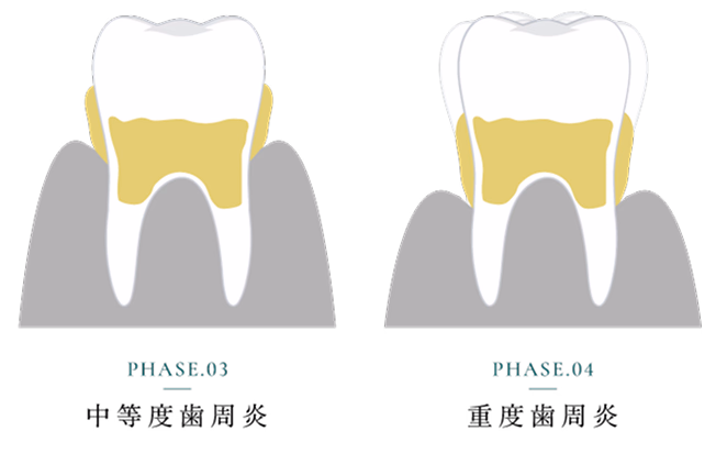 歯周病後期から重度の進行を示すイラスト(PHASE3とPHASE4)