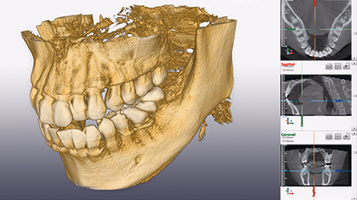 顎骨と歯を立体的に再現した3D CT画像