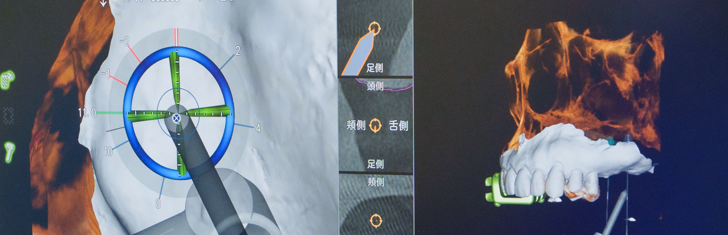 インプラント手術用ナビゲーションソフトの3D表示画面