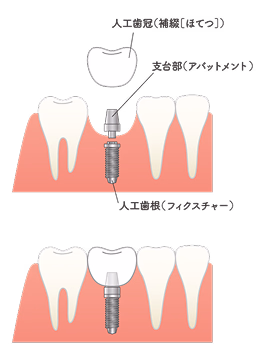歯科インプラントの構造図。人工歯、アバットメント、フィクスチャーの3つのパーツで構成されている