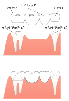 歯を削って支台歯に被せ物を装着するブリッジ治療の仕組みを示したイラスト