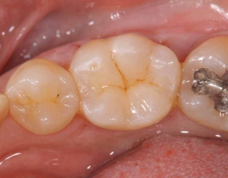 臼歯の虫歯治療後。白いレジン修復が施され、咬合面が自然な形態に回復した口腔内写真