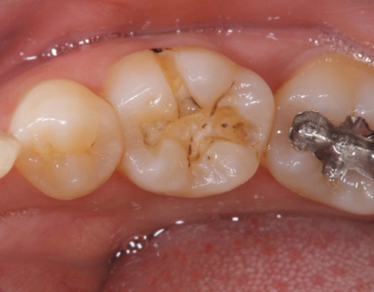 臼歯に広範な虫歯が認められ、咬合面に褐色の崩壊が見られる治療前の口腔内写真