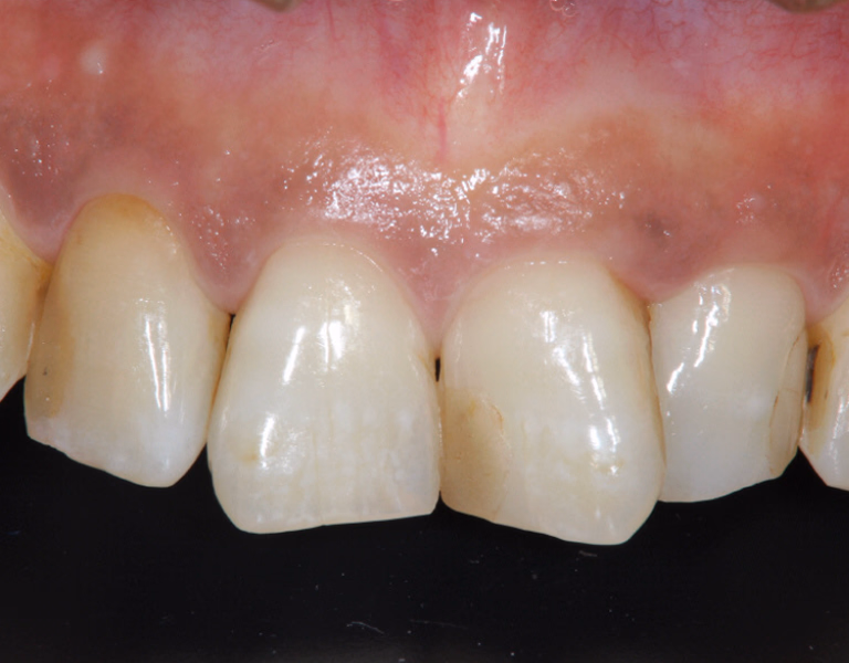 上顎前歯部の摩耗、変色、小さな欠けが見られる治療前の口腔内写真
