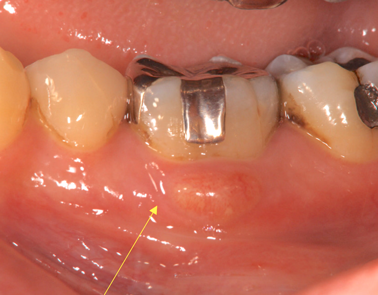 根管治療前と思われる臼歯部のデンタルX線画像で、根尖部に透過像が見られる。