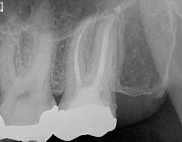 治療後の下顎臼歯部のX線画像で、根尖部が改善している様子が確認できる。