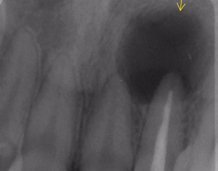 前歯部の根管治療前のデンタルX線画像で、根尖部に大きな透過像が認められる。