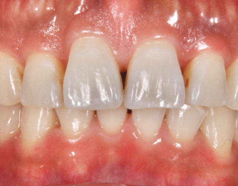 ホワイトニング後の前歯のアップ。歯の色が明るくなり、均一な白さが確認できる。